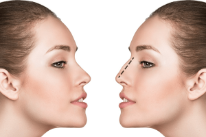 Rinoplastie - chirurgie estetica nas