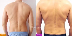 lipoaspiratie burta lombar