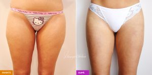 lipoaspiratie coapse