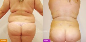 lipoaspiratie regiune lombara01