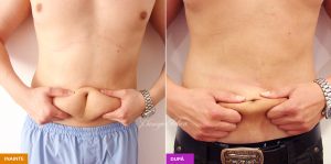 lipoaspiratie burta lombar