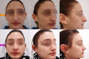 rinoplastie-caz2