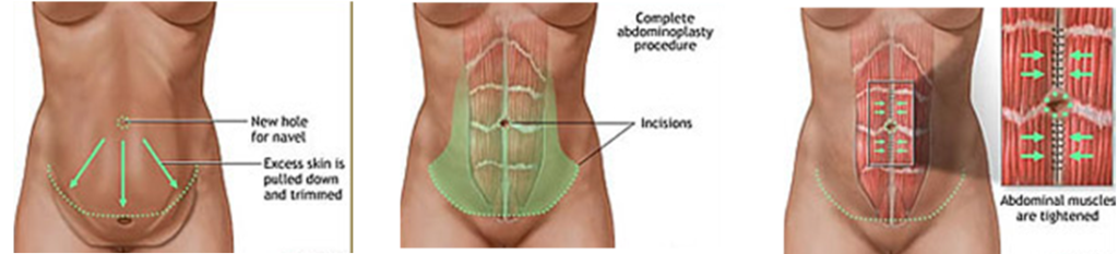 Abdominoplastia - detalii
