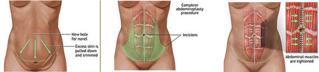 abdominoplastie cu venele varicoase cum să faceți atacuri în varicoză