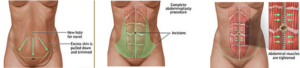 Abdominoplastia - detalii