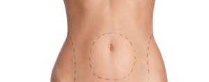 Chirurgie estetica - Abdominoplastia