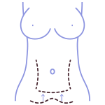 cura-chirurgical-a-diastazisului-de-muschi-abdominali